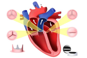 heart surgery key hole